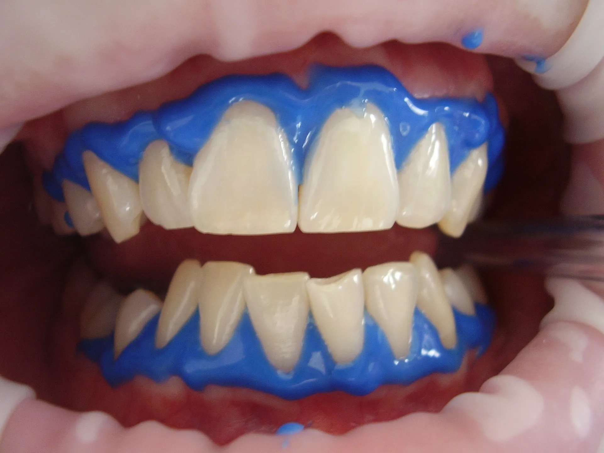 dents blancs